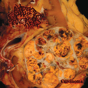 BLASTED PANCREAS | CARCINOMA